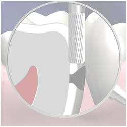 Fillings