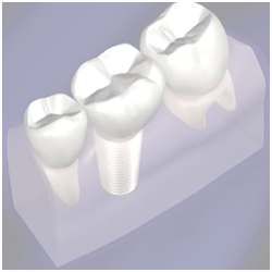 Implants
