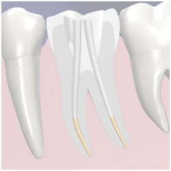 Root Canal Therapy